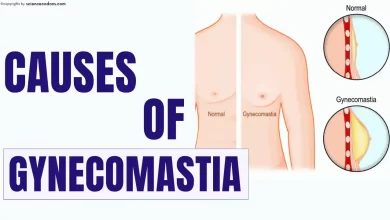 Gynecomastia causes