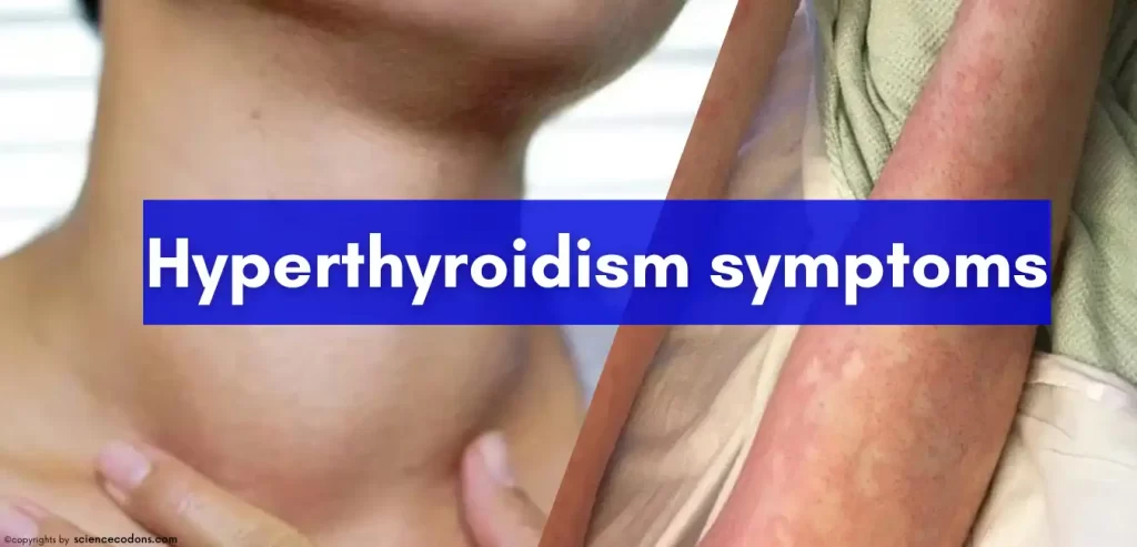 Hyperthyroidism symptoms 