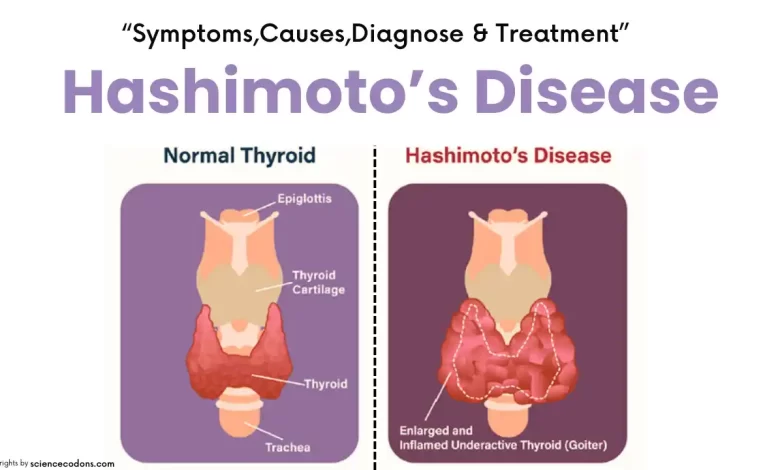 Hashimoto’s Disease