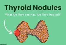 Thyroid Nodules Symptoms Diagnosed & Treatment